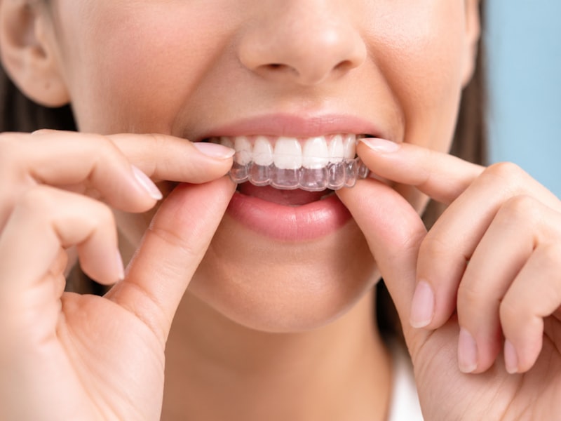 Clear dental aligner being placed