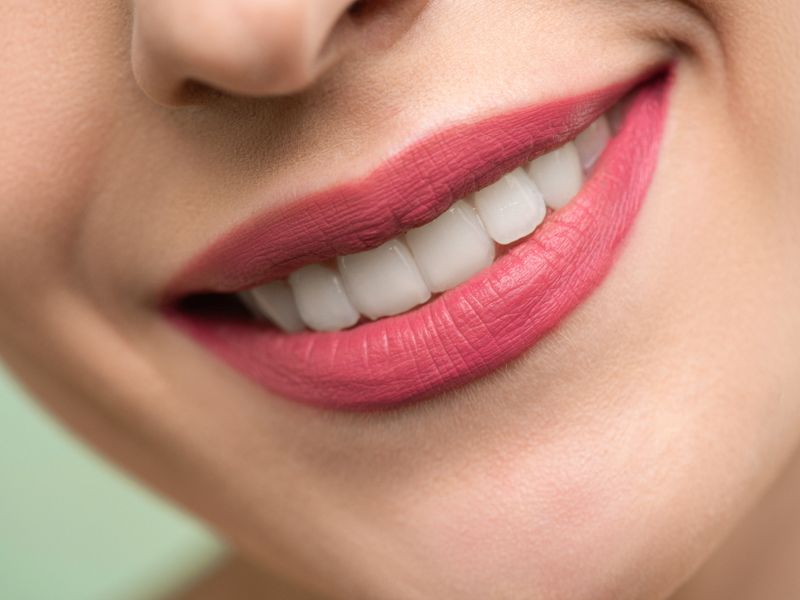 Bright smile illustrating veneers